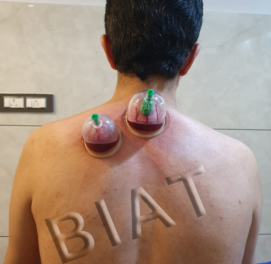 hijama